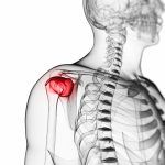 bursitis