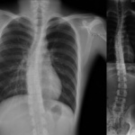 escoliosis2