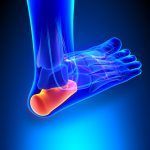 fascitis-plantar