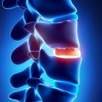 hernia